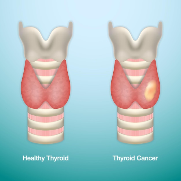 Vector healthy thyroid and thyroid cancer eps10 vector illustration