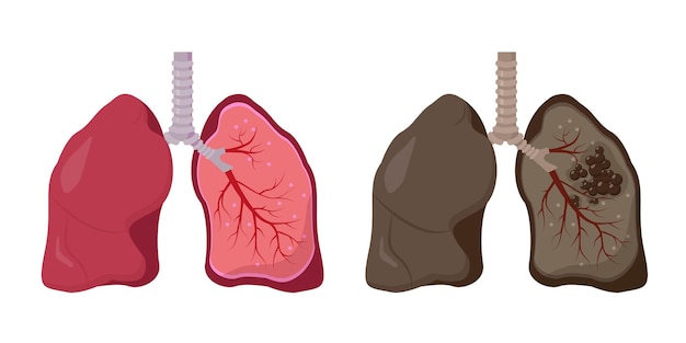 Vector healthy and unhealthy human lungs. normal lung vs lung cancer.