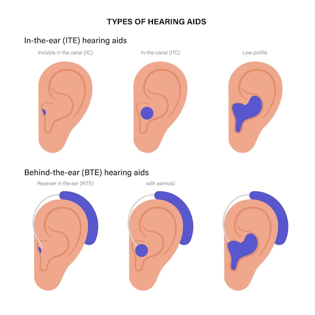 Vector hearing aids types