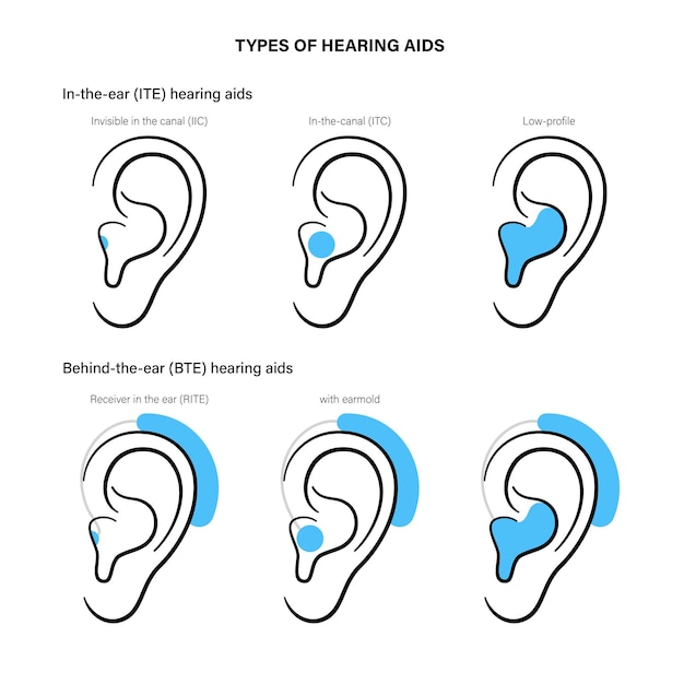 Vector hearing aids types