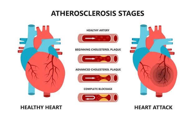 Vector heart attack and atherosclerosis stages cholesterol in the blood vessels