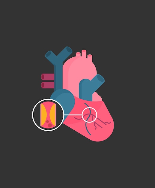 Vector heart attack concept in flat style vector image