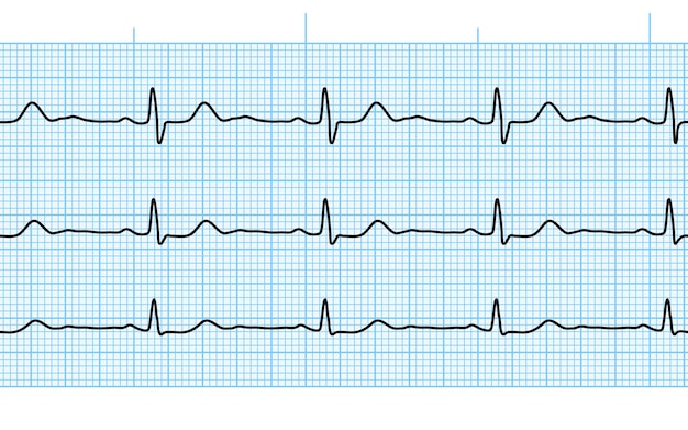 Vector heart beat ecg or ekg seamless black line on blue paper