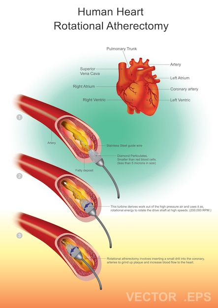 Vettore angioplastica con cuore di diamante