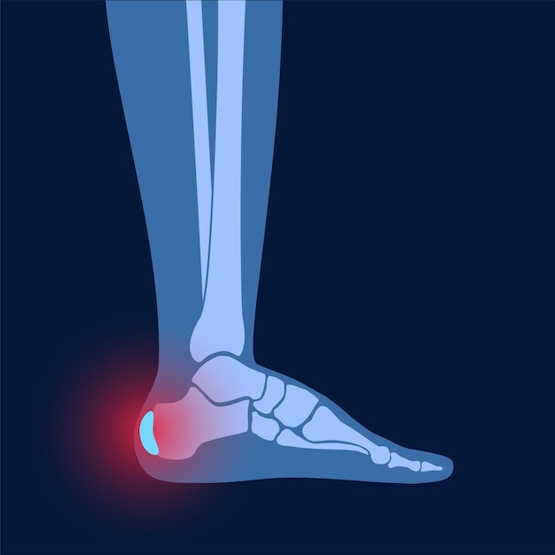 발 뒤꿈치 활액낭염 염증. 인간의 발목에 염증이 생긴 점액낭. 아킬레스건과 족부질환