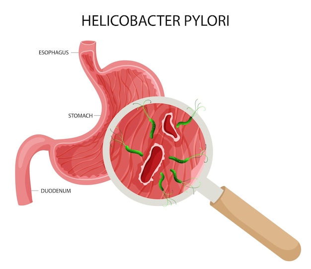 Helicobacter pylori bij maagzweer