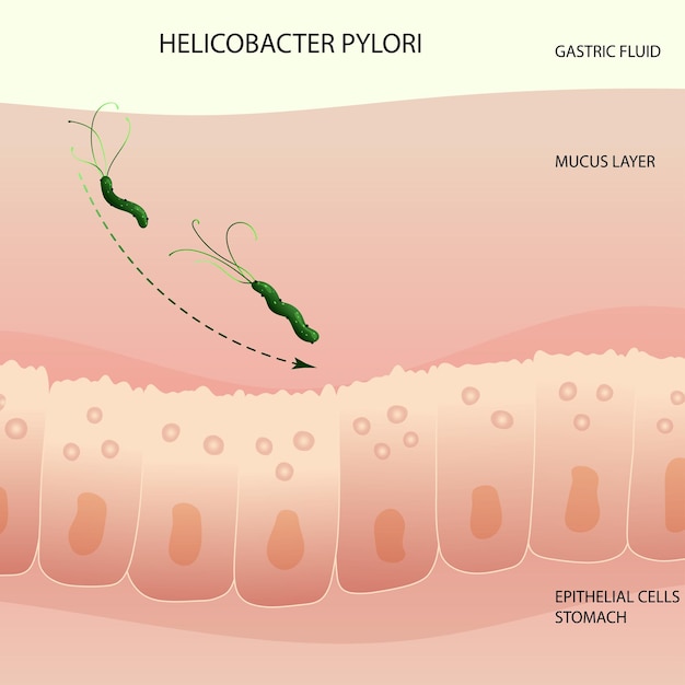 Helicobacter pylori-infectieproces in de menselijke maag