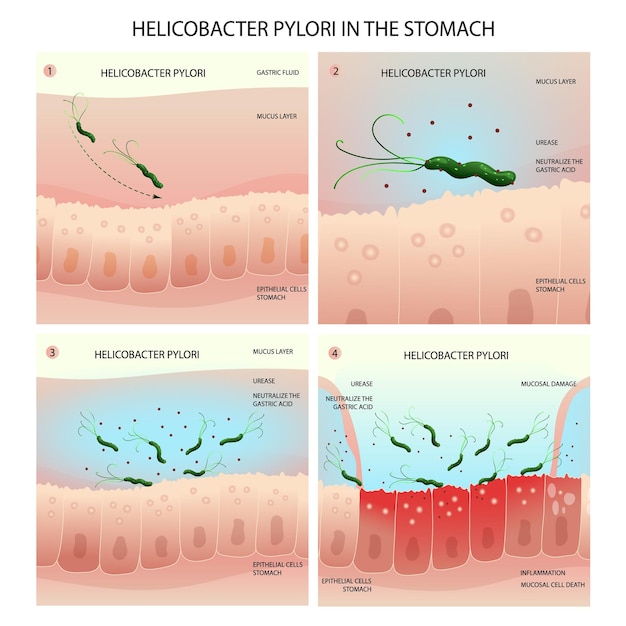 Vector helicobacter pylori infection process in human stomach