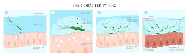 Vettore processo di infezione da helicobacter pylori nell'infografica dello strato mucoso dello stomaco