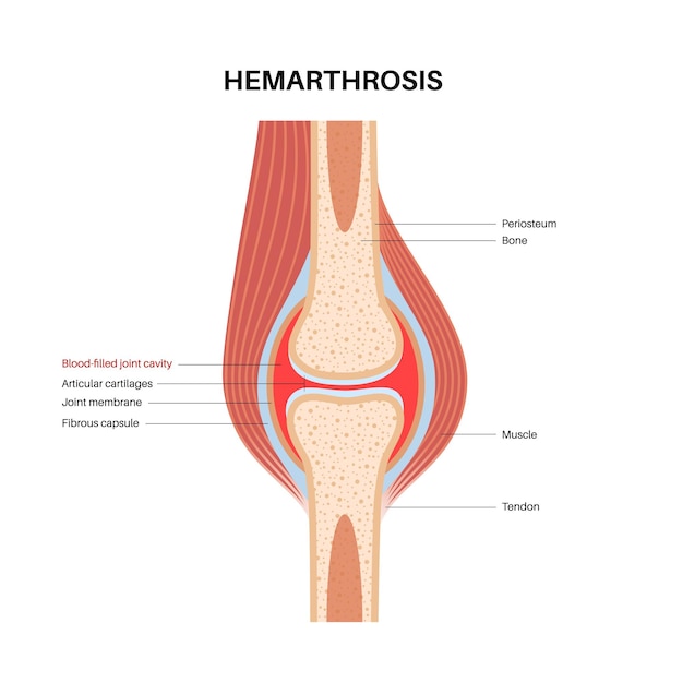 Vector hemarthrosis in the synovial joint