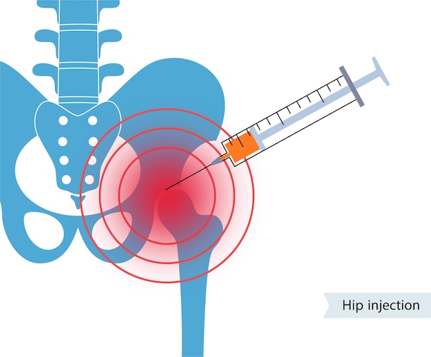 Vector heupgewricht injectie