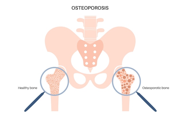 Hip bone fracture poster Leg injury concept Broken femur bone systemic skeletal disorder