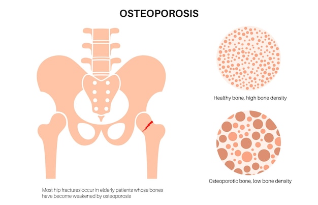 Hip bone fracture poster Leg injury concept Broken femur bone systemic skeletal disorder