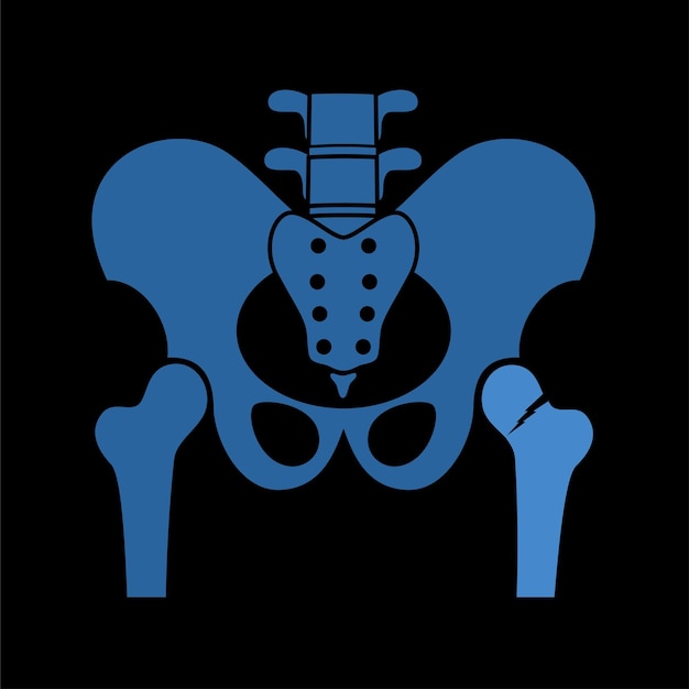 Hip bone fracture poster Leg injury concept Broken femur bone