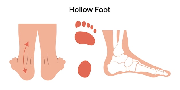 Vector hollow foot deformity