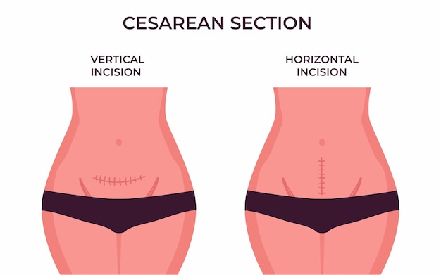 Vector horizontal and vertical incision types of incisions in cesarean delivery.