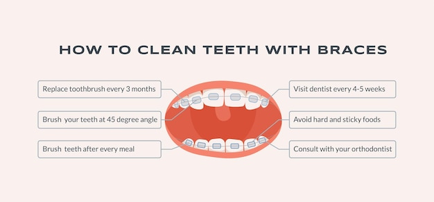 Come pulire i denti con le parentesi graffe illustrazione piatta