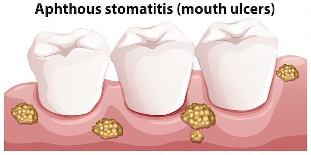 Vettore anatomia umana della stomatite aftosa