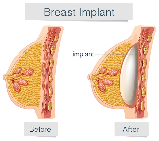 유방 임플란트의 인체 해부학