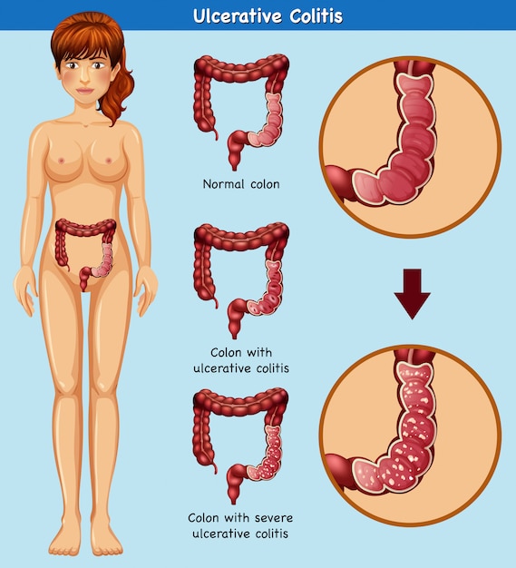 潰瘍性大腸炎の人体解剖