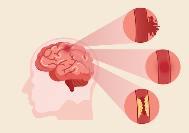 Illustrazione di ictus del cervello umano.