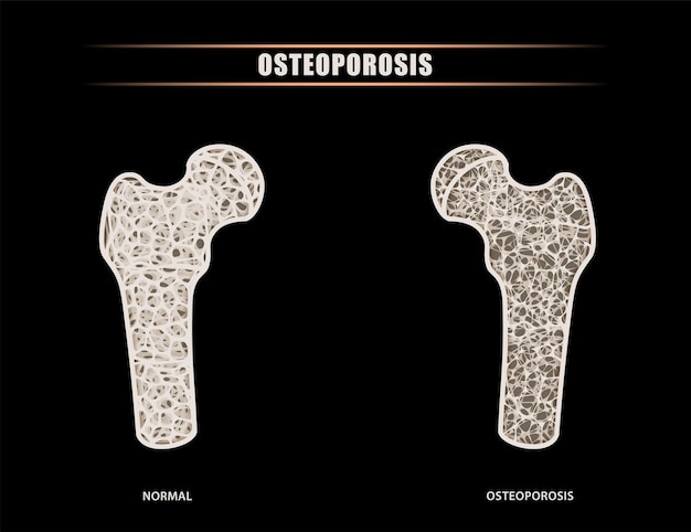 Vector a human femur versus hip intraarticular comparison of normal bone symptoms with osteoporosis