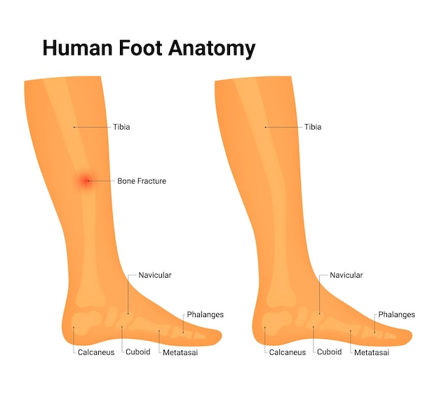 Vector human foot anatomy vector illustration tibia bone fracture navicular phalanges calcaneus