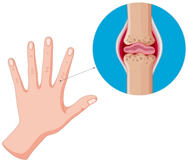 Vector human hand and bad joints, arthritis