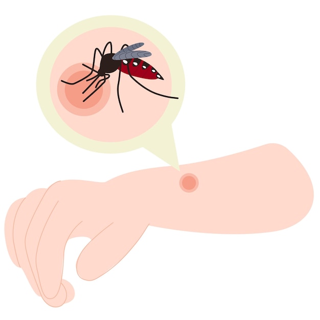 Vector the human hand with the mosquito bite mosquito bite hand mosquito bite healthcare illustration