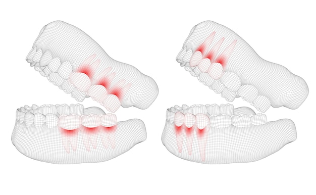 ベクトル 人間の顎の3dレイアウト医学と健康の痛みの歯