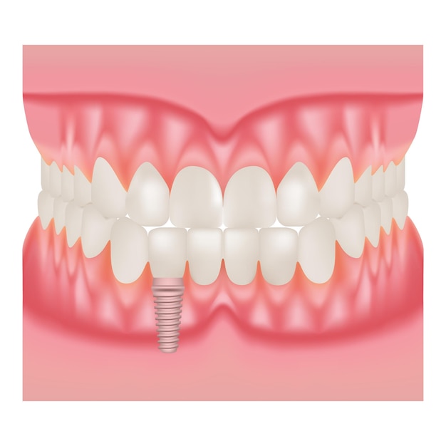 치아와 흰색 배경 벡터 일러스트 레이 션에 고립 된 치과 임플란트의 임플란트 설치와 인간의 턱 모델