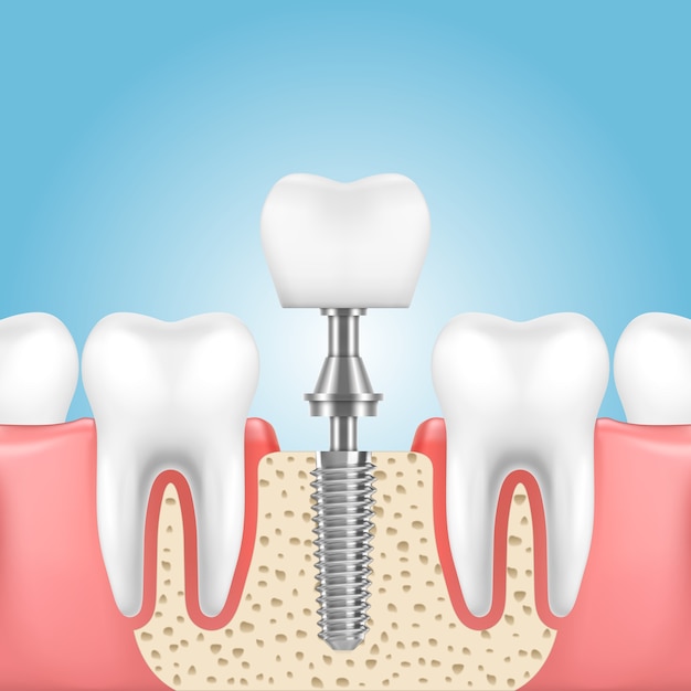 Human jaw with health teeth and prosthesis with implant crown