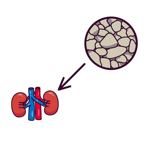 Vector human kidneys with stones in them sick organ of the genitourinary system kidney disease poster for a children39s book on medicine