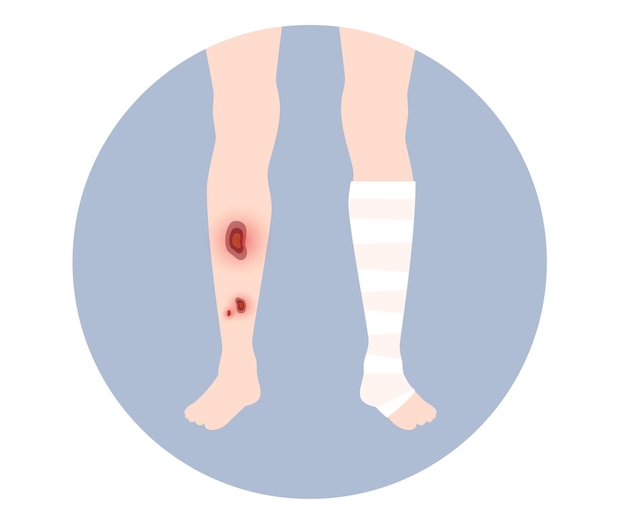 Vector human leg injury