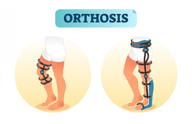 Equipaggiamento medico per ortesi delle gambe umane