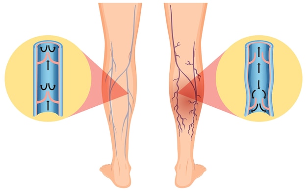 Vettore gambe umane con vene varicose