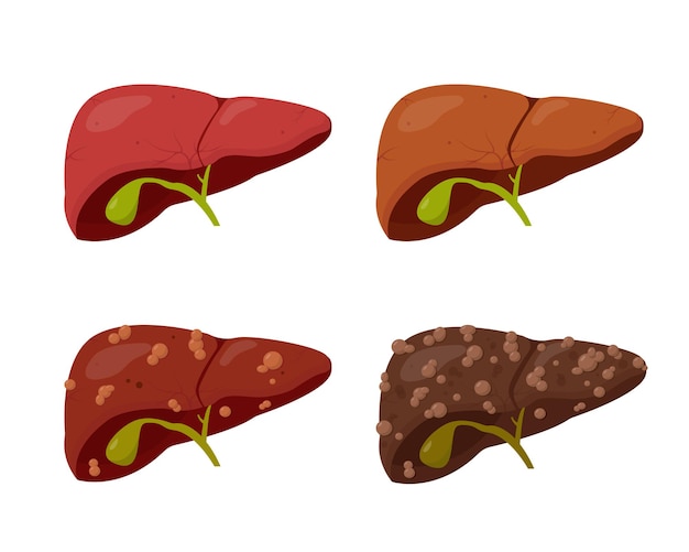 Vector human liver set isolated on white background. stages of liver disease.