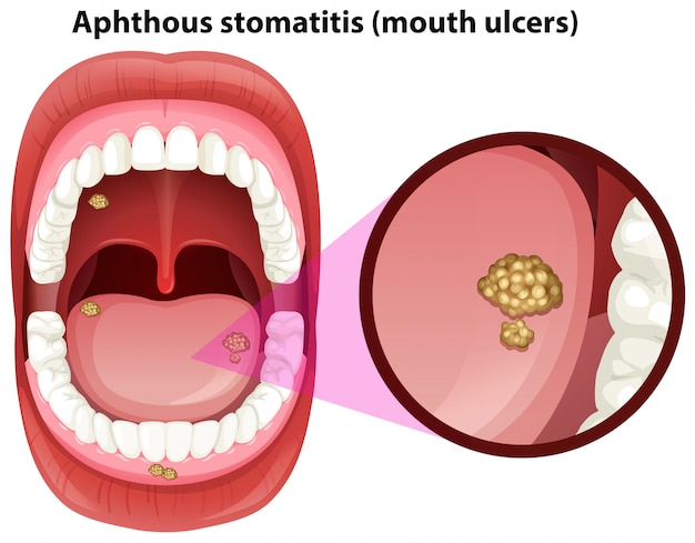 Human mouth anatomy of ulcers