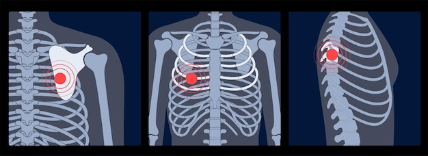 Dolore umano, frattura o infiammazione nella gabbia toracica. illustrazione vettoriale piatto anatomico