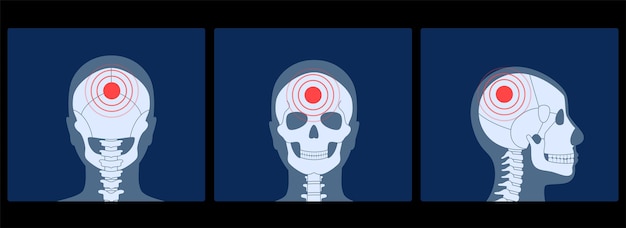 Vector human skull pain, fracture or inflammation in front, profile and back on x ray view