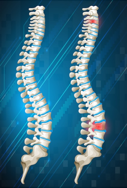 Human spines with red inflamed on one