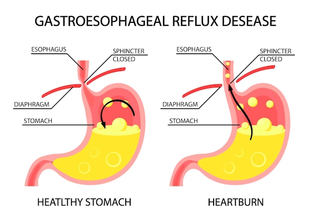 Vector human stomach gastroesophageal reflux disease gerd heartburn gastric infographics