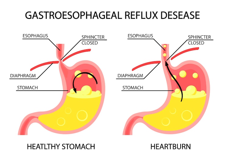Human stomach Gastroesophageal reflux disease GERD heartburn gastric infographics