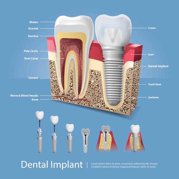 Человеческие зубы и зубной имплантат иллюстрация
