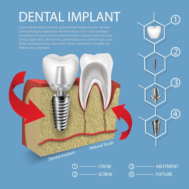 Вектор человеческих зубов и зубных имплантатов в макете десен
