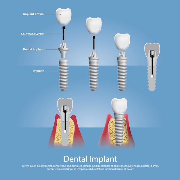 Human teeth and dental implant illustration