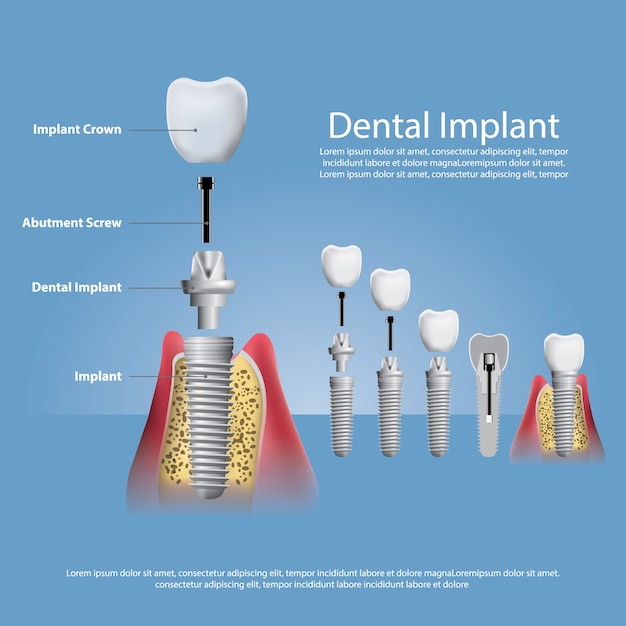 Vector human teeth and dental implant  illustration