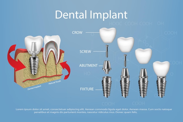 Vettore denti umani e vettore di impianto dentale nel mockup di gengive