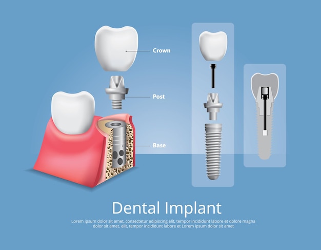 Human teeth and dental implant vector illustration