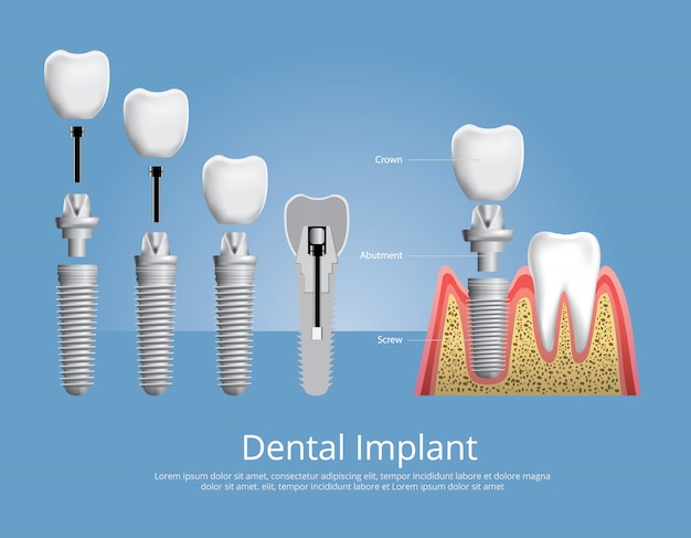 Denti umani e illustrazione di vettore dell'impianto dentale